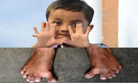25 fingers boy in India